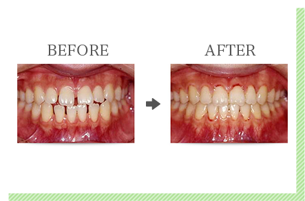 前歯だけの「部分矯正」